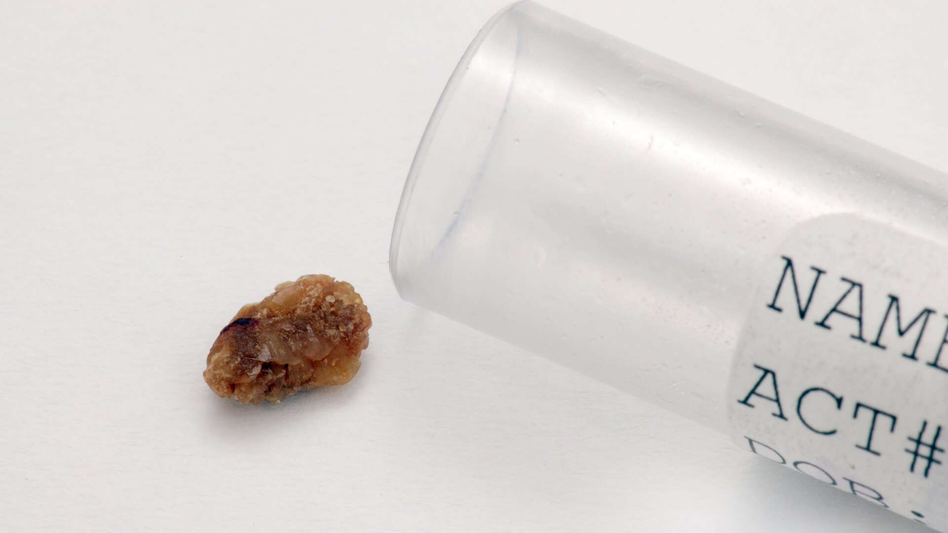 kidney stone next to a vial